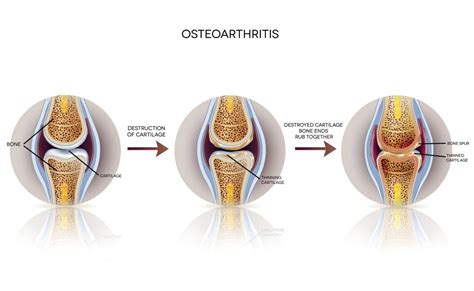 Menshikova osteoartriti